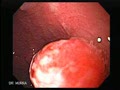 Gastric polyp