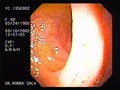 Ileo-transverse anastomosis (end to side)